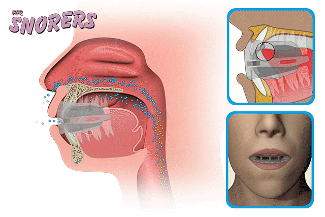 for snorers more info 1r