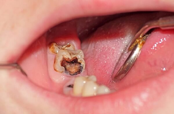 Răng bị tổn thương, cấu trúc răng bị hủy và có lỗ sâu