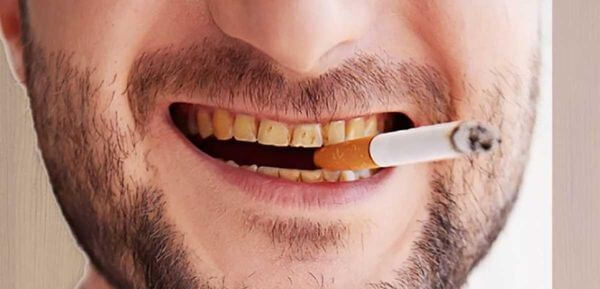 Hút thuốc là một trong những nguyên nhân gây mảng bám đen trên răng