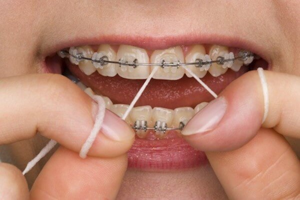 Cách dùng chỉ nha khoa cho người niềng răng