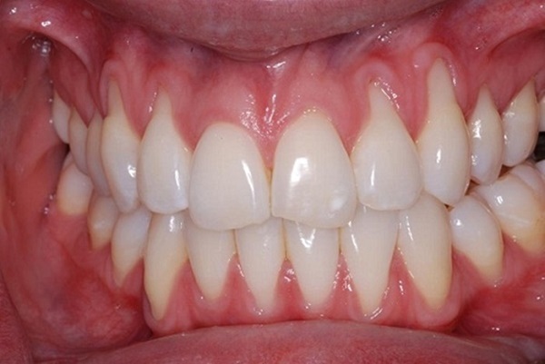 Nguyên nhân bị ê buốt răng do tụt nướu, viêm chân răng