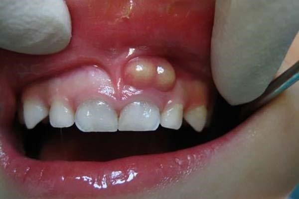 Dấu hiệu mọc răng khôn khi bị chảy mủ chân răng