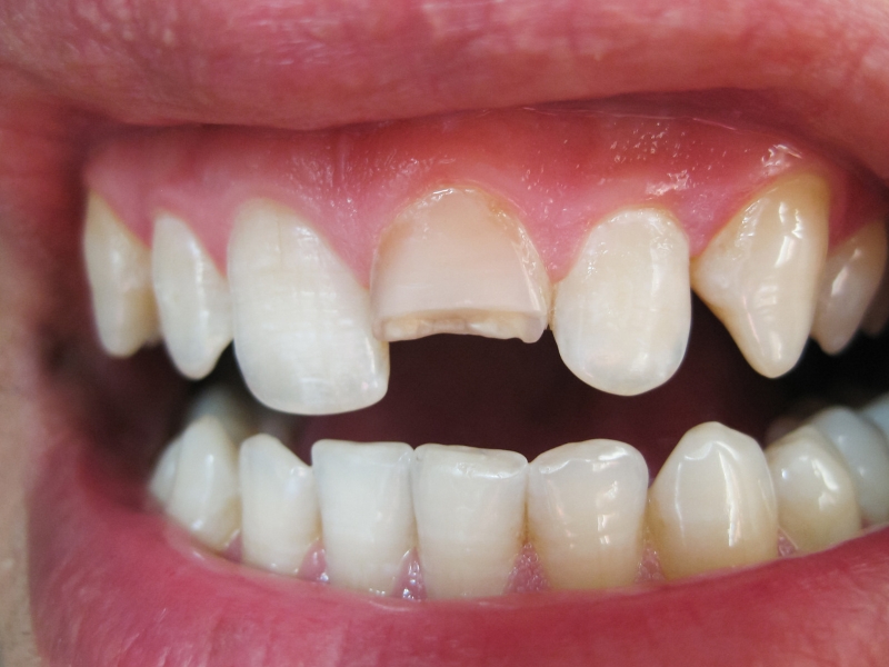 Tìm hiểu một số nguyên nhân gây vỡ răng