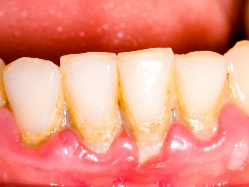 Nguyên nhân viêm nha chu do: vi khuẩn có hại trong mảng bám và tích tụ vôi răng