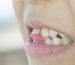 Răng bị lung lay là vấn đề khá phổ biến hiện nay