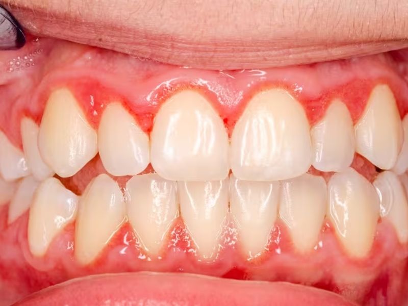 Khái niệm viêm nướu răng