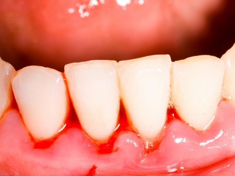 Bệnh viêm nha chu là một trong những nguyên nhân của răng lung lay