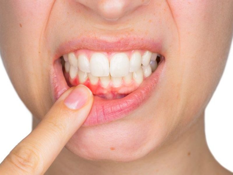 Các dấu hiệu viêm nướu răng thường gặp