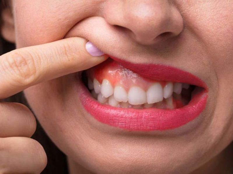 Nguyên nhân dẫn đến tình trạng viêm nướu ở răng