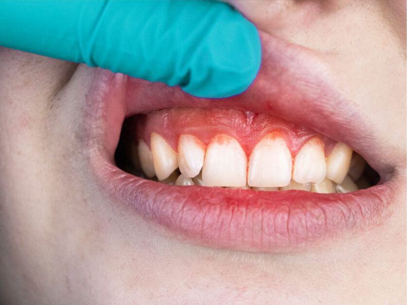 Một số cách phòng ngừa viêm nướu ở răng