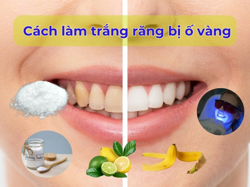 Các cách tẩy trắng răng bị ố vàng