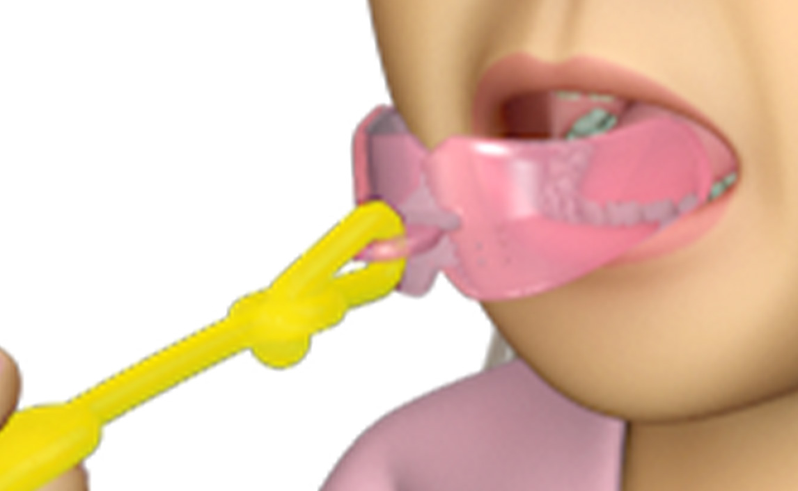 Bộ Lip Trainer&trade; – LT v&agrave; Lip Seal Trainer – LST